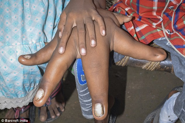 His hands now measure 13 inches from the base of his palm to the tip of his middle finger and weigh two stone