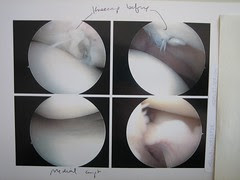 torn cartilage knee