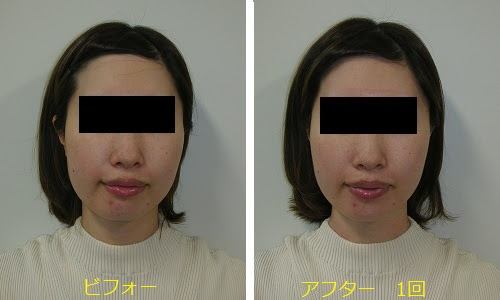 小顔矯正 顎エラ頬の非対称顔歪み専門 関西プロポーション小顔センター大阪梅田院 整体 顎関節症