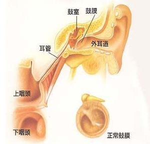 耳膜内陷是怎么回事 耳鼻喉