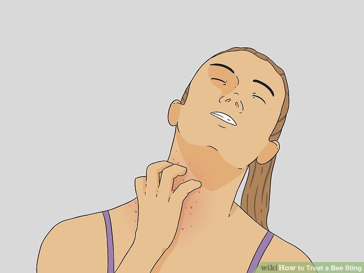 Treat a Bee Sting Step 3 Version 3.jpg
