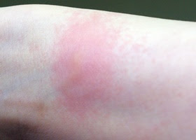ヘビイチゴは優秀な漢方薬 焼酎漬けの効能効果は虫刺されやニキビにも Lettre Du Nature