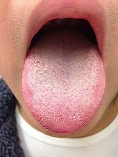 赤い舌 野田市 小児科 千葉県 こどもの花粉症 こどもの漢方 喘息 アトピー性皮膚炎 アレルギー 結節性痒疹 たんぽぽこどもクリニック