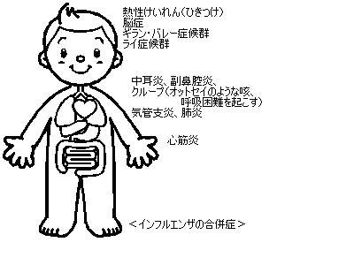 インフルエンザってどんな病気