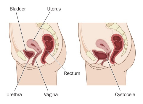 Prolapse Perth Urology Clinic