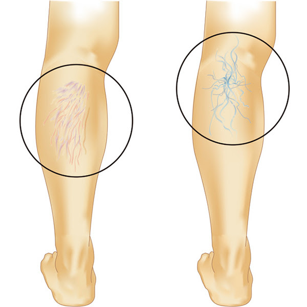 川崎市の溝の口慶友クリニックでは下肢静脈瘤外来を行っております