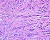 Skin Cancer Metastasis : Multiple cutaneous squamous cell carcinomas: Primary - Skin cancer is by far the most common type of cancer.