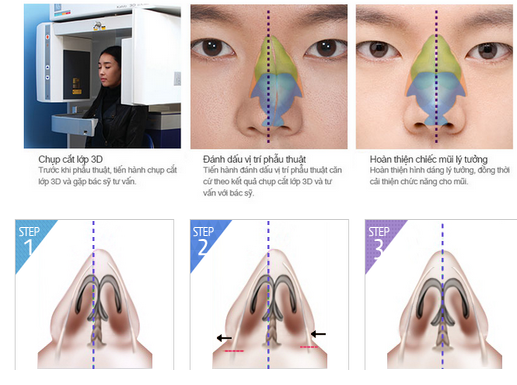 Xem cận cảnh phẫu thuật nâng mũi tại BVTM Kangnam