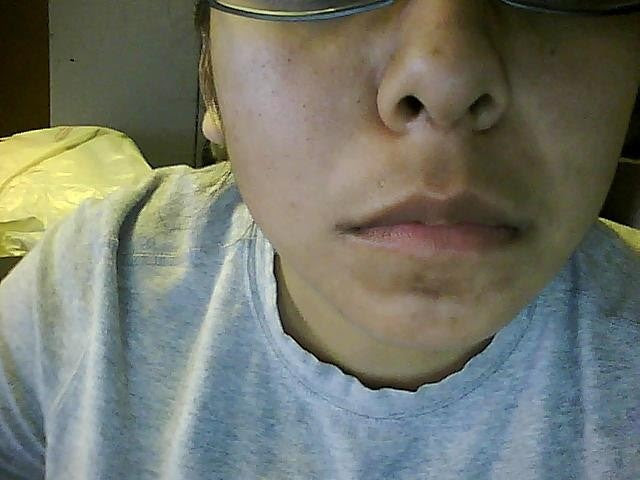Dark upper lip is a lip discoloration problem that can be caused due to a 