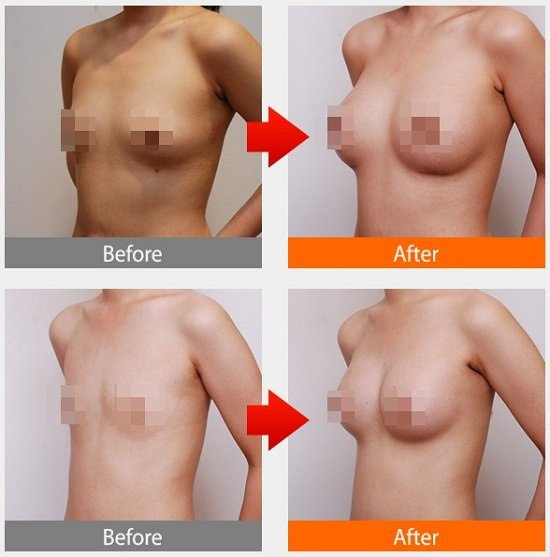 Kim Yến thực hiện nâng ngực nội soi