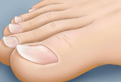 ماذا تقول شكل أظافرك عن صحتك