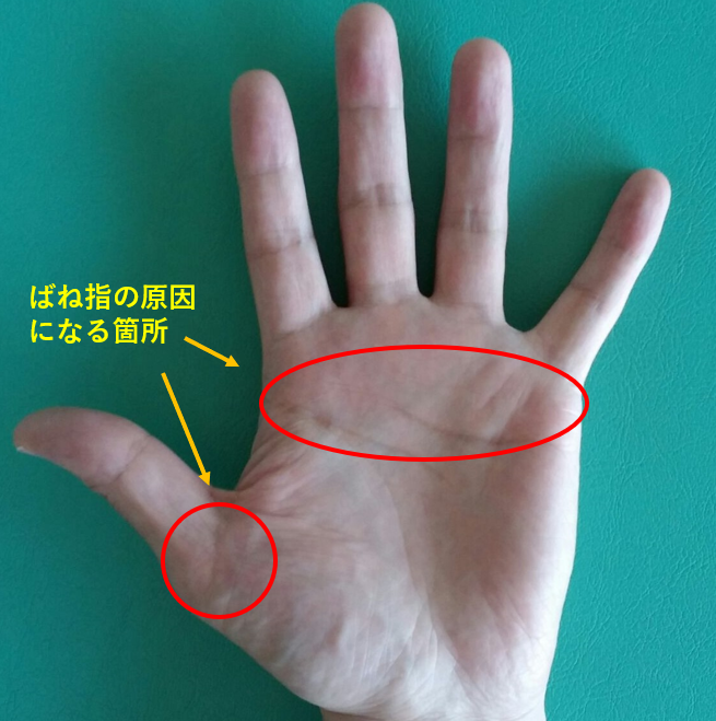 指が曲がったまま戻せない それは弾発指 ばね指 かも チェックリストで確認してみましょう すみだ整骨院 直方 飯塚 田川 八幡で整骨院なら