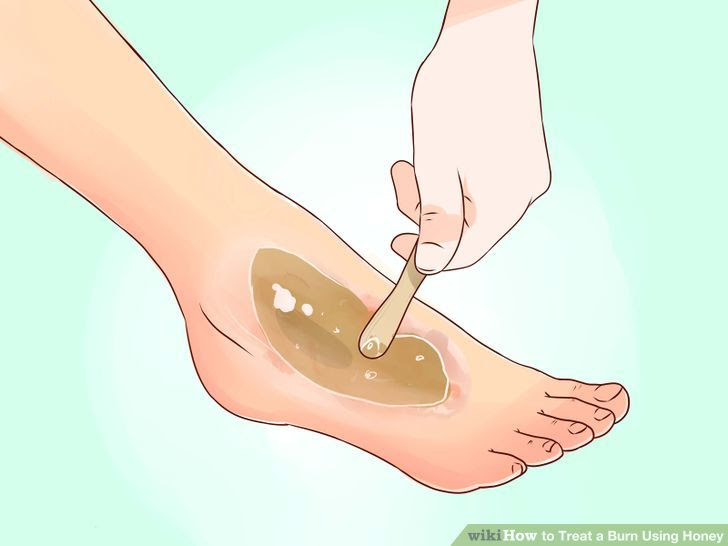 Treat a Burn Using Honey Step 6 Version 3.jpg