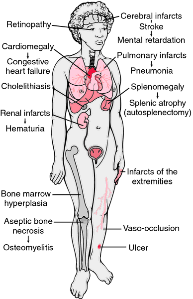 of Sickle Cell Disease. Hemolytic Disease Of The Newborn. of Sickle Cell Disease.
