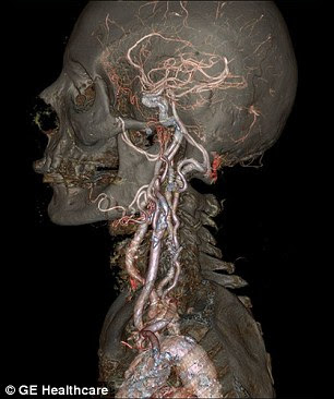 Pictured are high-definition images of the skull and the Circle of Willis, which supplies blood to the brain