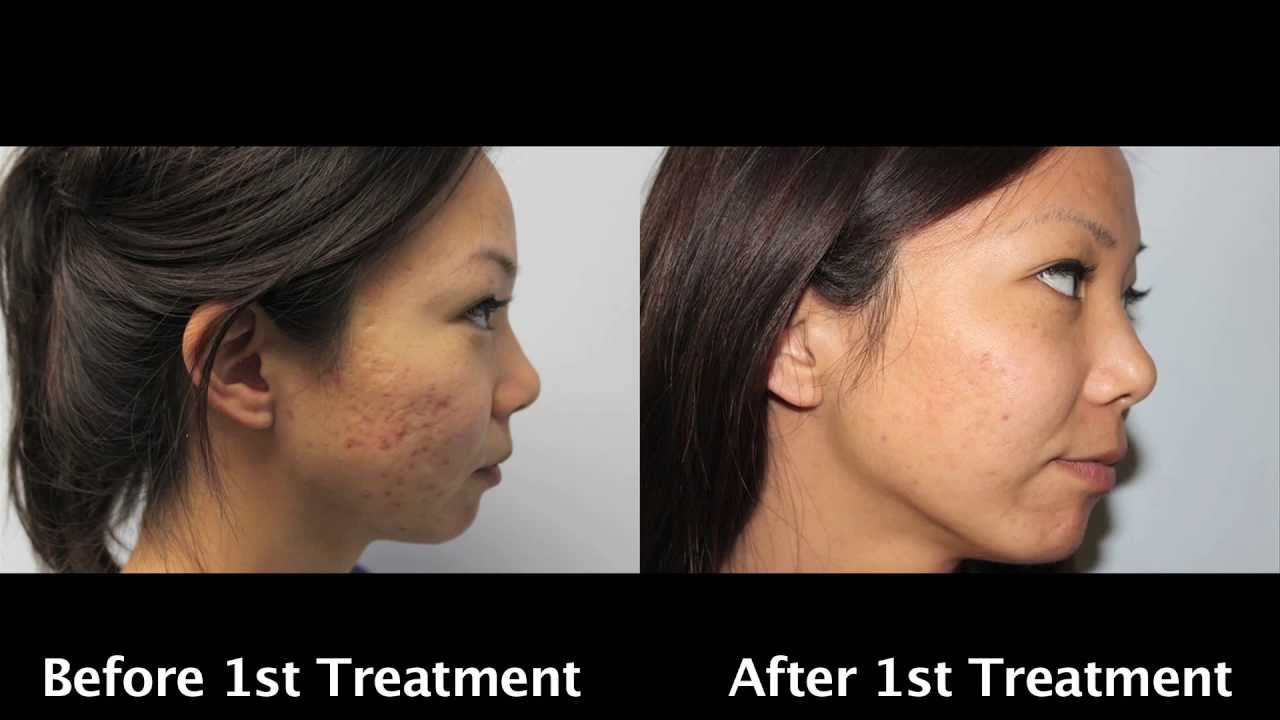 best pimples cleaner for oily skin