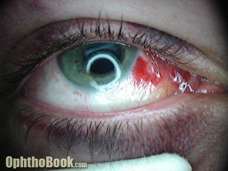 A subconjunctival hemorrhage