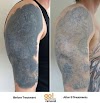 Blackout Tattoo Removal Before And After