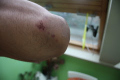 Grazed Elbow