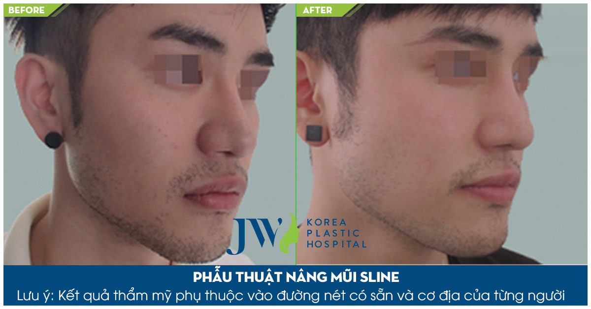 Chàng trai nâng cao sóng mũi đẹp tự nhiên nhờ phẫu thuật nâng mũi S Line