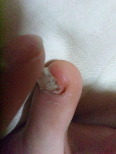悲報 足の小指の爪が剥がれかける ７月末に負傷した両足の小指の 写真共有サイト フォト蔵