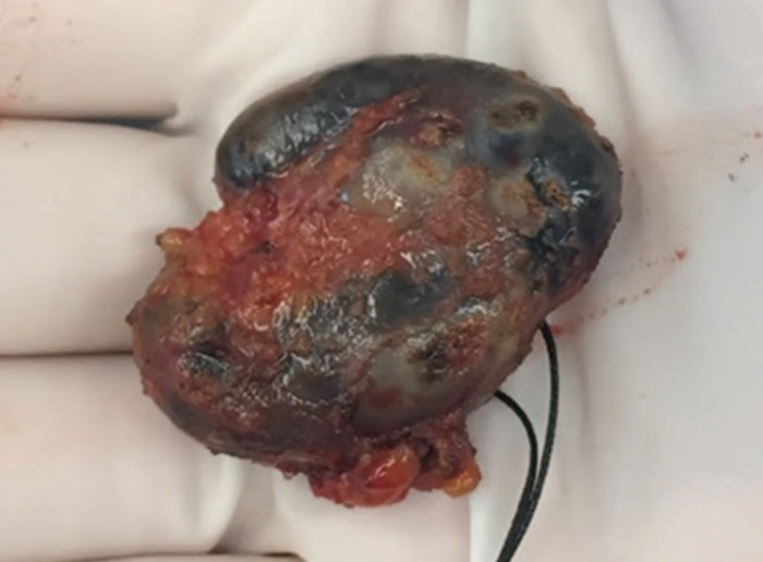 15-year-old tattoo caused a cancer-like reaction in a ...