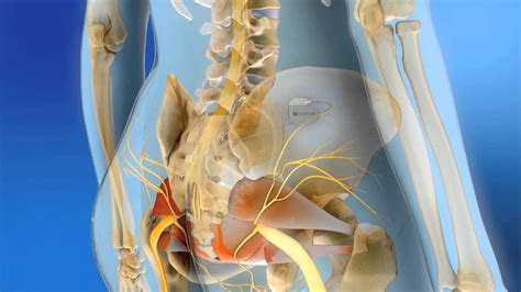 The most common symptom is a sudden, uncontrolled need or urge to . Medtronic Sacral Neuromodulation - YouTube