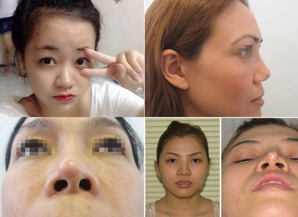 Nâng mũi bọc sụn 4