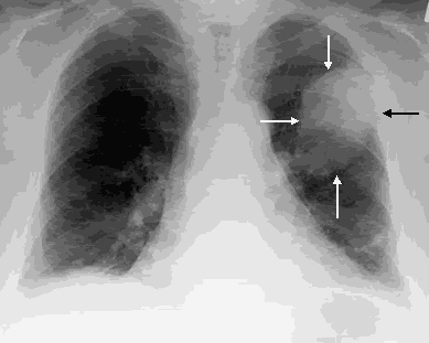 pics of lungs before and after smoking. susceptible to lung cancer
