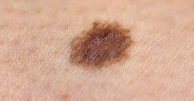 Melanoma Warning Signs Skin Cancer Types : Skin Cancer Leg | Pictures of Skin Cancer on Legs | Skin : Some types of skin cancer are more dangerous than others, but if you have a spot.