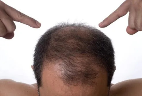 A man points to his thinning hair.