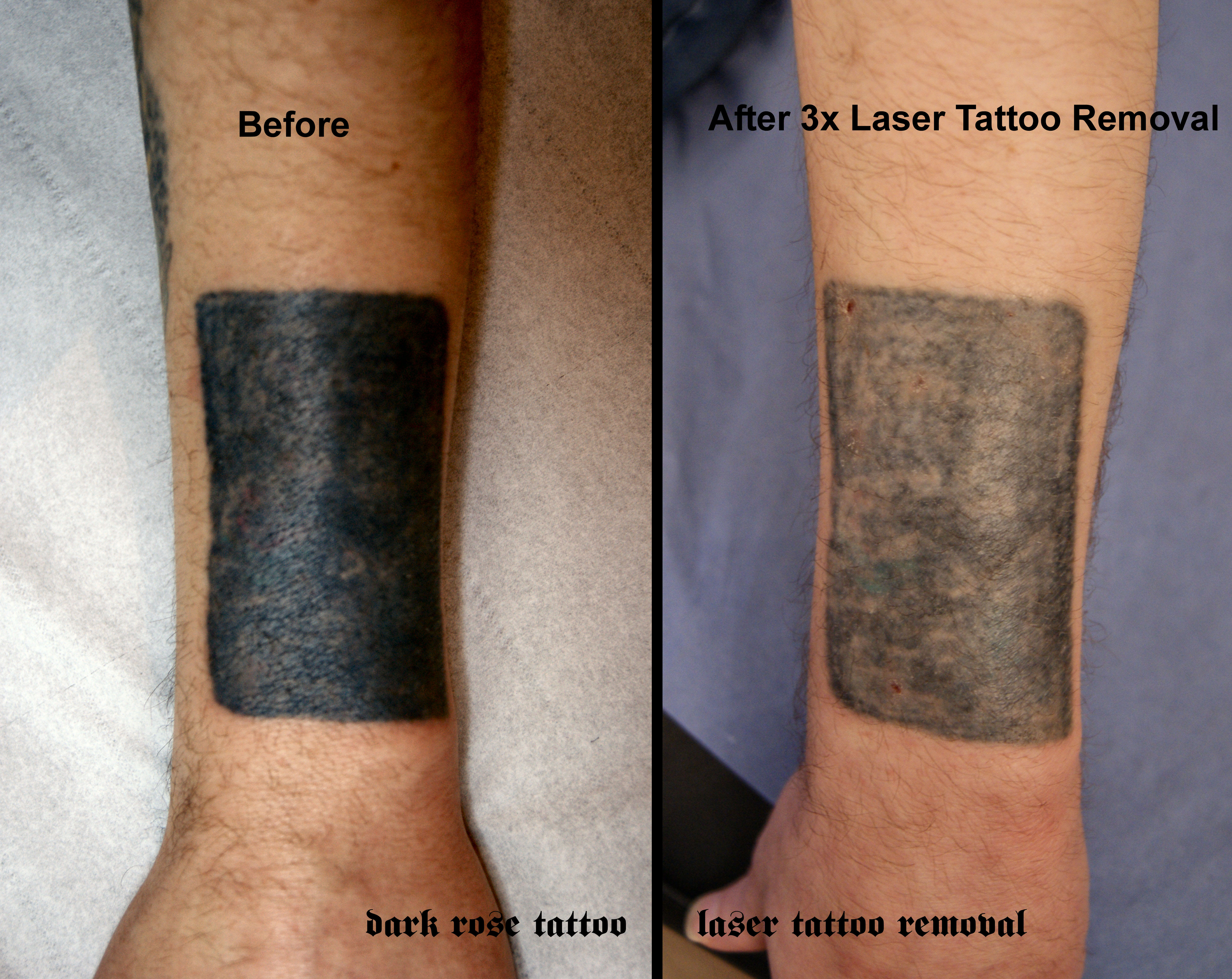 Ideas Tattoos - Tattos design, tattoos ideas, tattos removal
