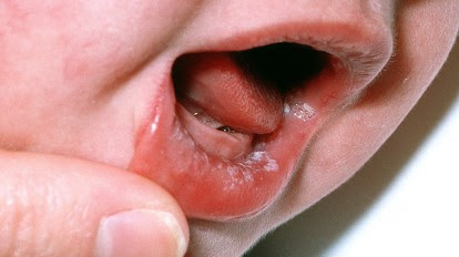 Thrush In Babies What Is Oral Thrush In Infants And How Is It Treated