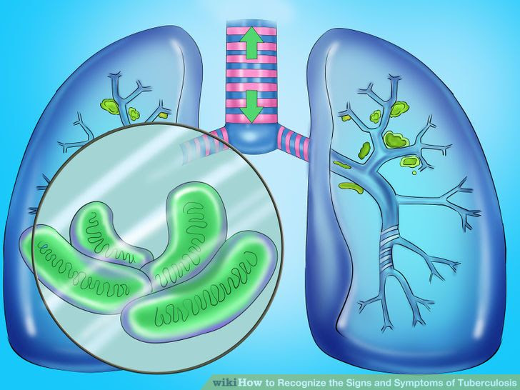 Recognize the Signs and Symptoms of Tuberculosis Step 10.jpg