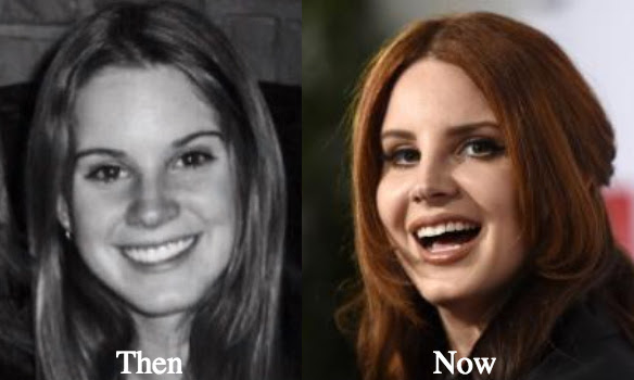 Lana Del Rey Plastic Surgery Before and After Photos ...