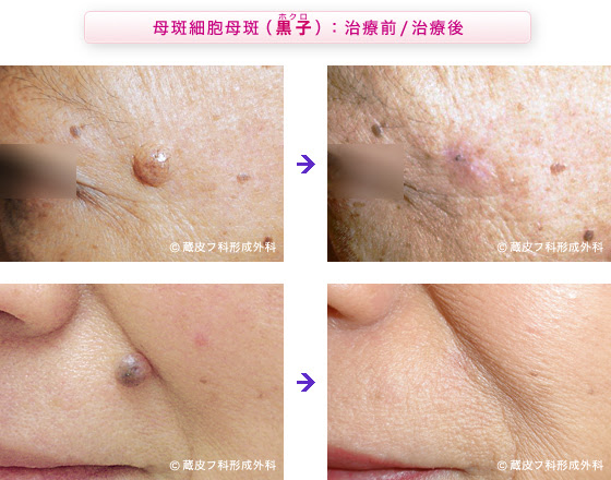 黒子 ほくろ の治療と手術 蔵皮膚科 形成外科 東京都台東区 健康保険適用 病院