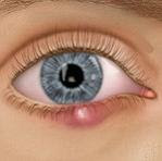 gözde sürekli arpacık olması gözümde devamlı arpacık çıkıyor göz kenarında arpacık