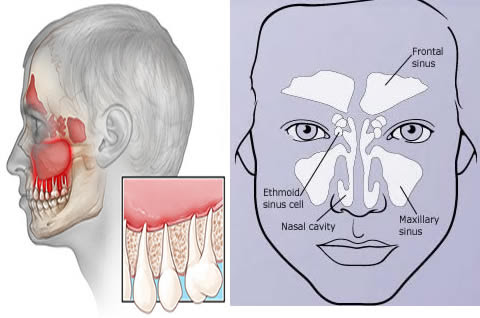 Is It Sinus Or Tooth Pain? - Parker Dentist Office