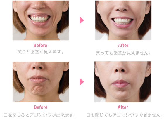 唇 薄く 厚く ガミースマイル 栃木県の美容外科 美容整形 宇都宮竹内クリニック