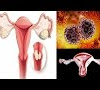 What Were Your Early Signs Of Cervical Cancer - 9 Signs of Cervical Cancer You Should Not Ignore ... - She explains that risk factors for cervical cancer include: