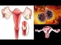 What Were Your Early Signs Of Cervical Cancer - 9 Signs of Cervical Cancer You Should Not Ignore ... - She explains that risk factors for cervical cancer include: