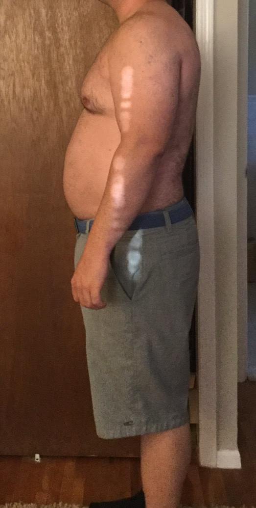 If I Lose This Weight Will I Get Loose Skin Pic R Fitness