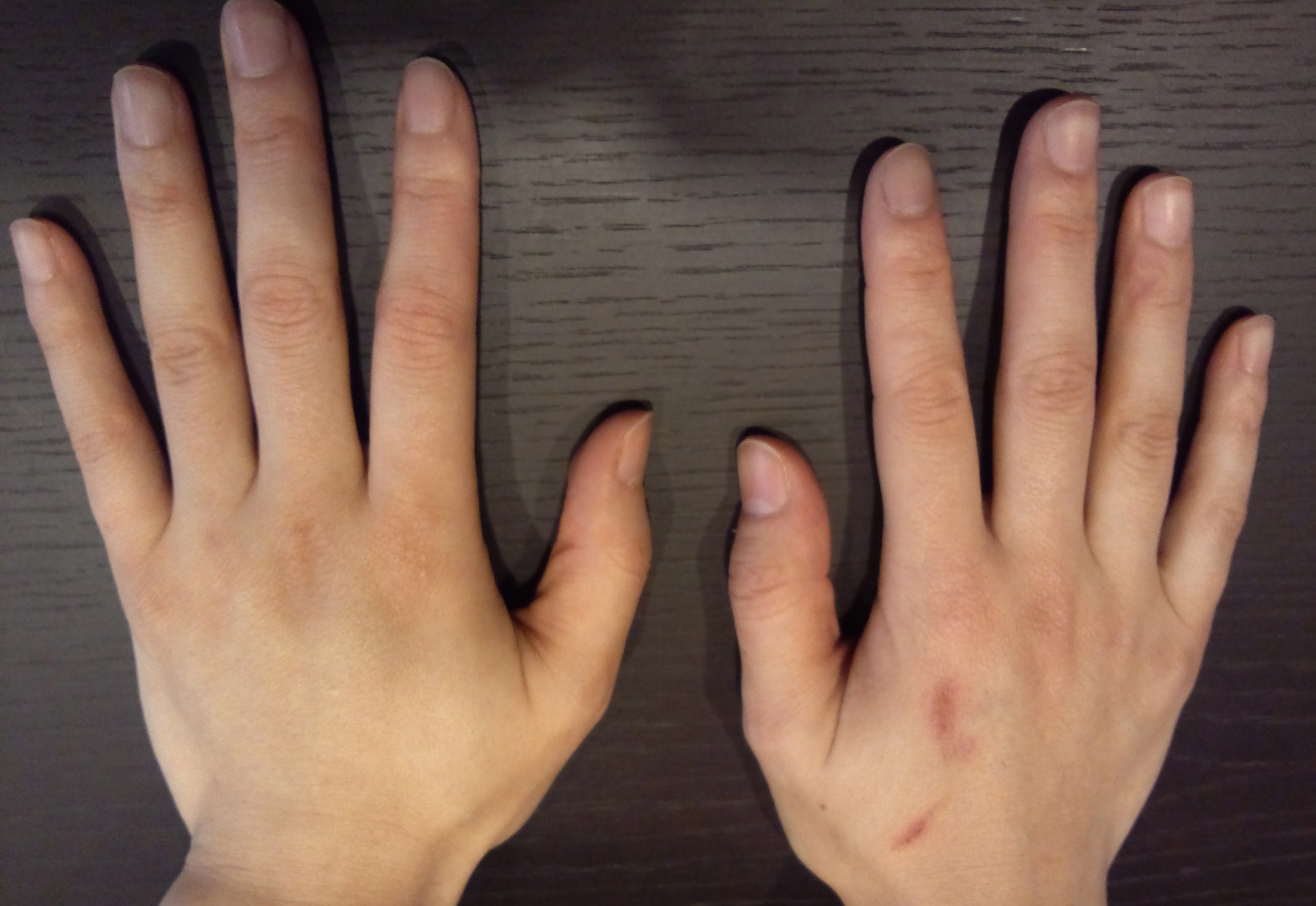 手の甲の若返り