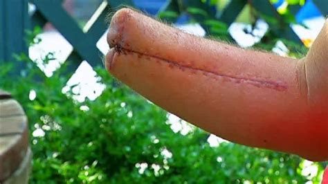 newport man survives flesh eating bacteria wjar