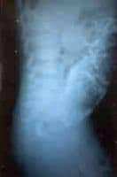 Hirschsprung disease. Contrast enema demonstrating