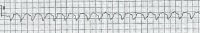 Monomorphic ventricular tachycardia. 