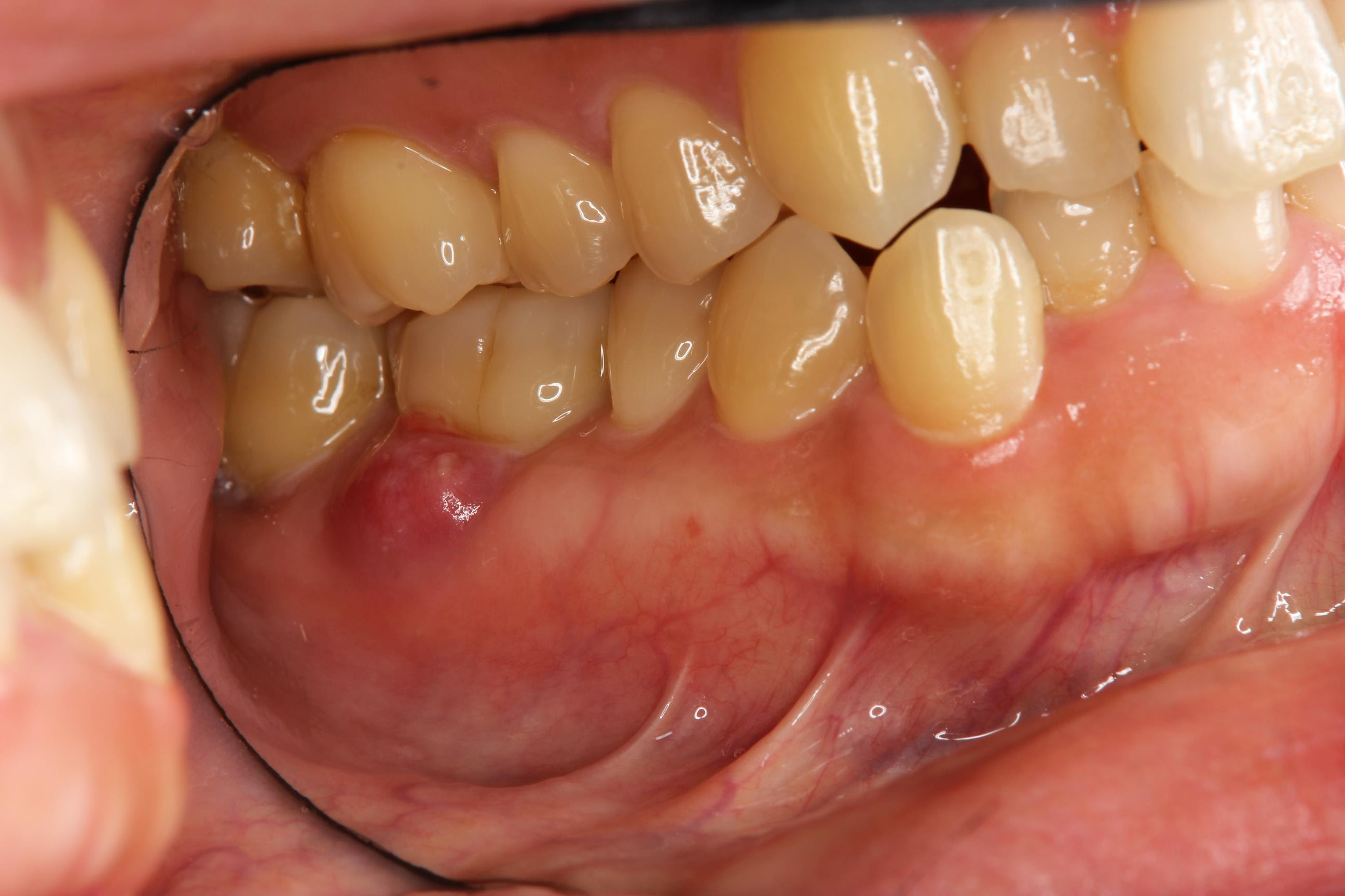 歯肉の腫れは 歯周病以外の原因も 石神井公園 歯医者 たけのうち歯科クリニック