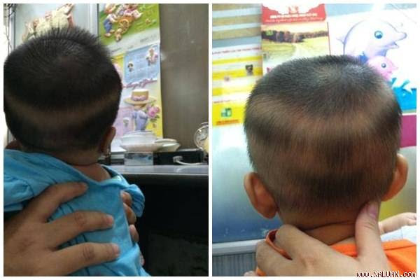  Hiện tượng rụng tóc vành khăn ở trẻ nhỏ. Ảnh: Bác sĩ Hào cung cấp