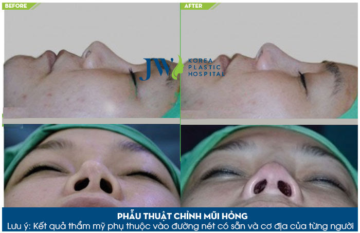 Sửa mũi theo công nghệ Hàn Quốc