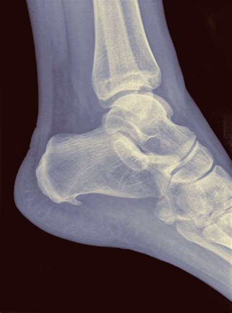 Get the latest news and events plantar fasciitis is a common condition that causes heel pain. Conditions Often Mistaken for Plantar Fasciitis